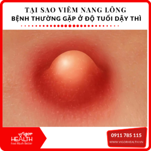 VIEM NANG LONG 1