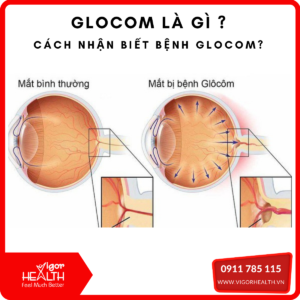 benh Glomcom